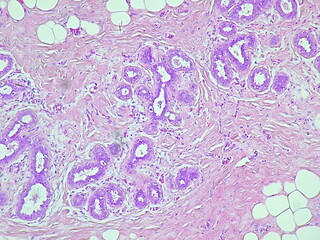 Human breast cell tissue under a microscope in a pathology laboratory. Microscopic view of...