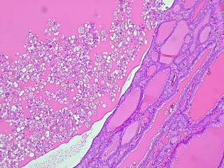 Photomicrograph showing histology of benign thyroid nodule under microscope with struma colloids...