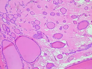 Photomicrograph showing histology of benign thyroid nodule under microscope with struma colloids cystica results in pathology laboratory