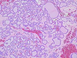 photomicrograph of Hashimoto's thyroiditis (chronic lymphocytic thyroiditis) in pathology anatomy laboratory