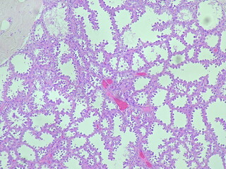 photomicrograph Histology of a breast biopsy from a pregnant woman showed a lactating adenoma under...