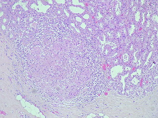 photomicrograph Histology of a breast biopsy from a pregnant woman showed a lactating adenoma under...