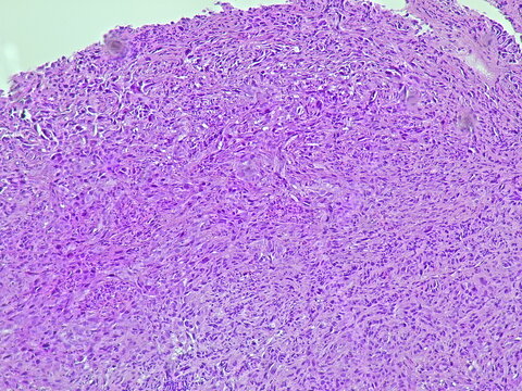 Photomicrograph of adenocarcinoma with patient diagnosis of hematemesis in anatomical pathology laboratory