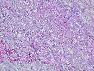 Photomicrograph of pyonephrosis + angiomyolipoma in a patient diagnosed with pyonephrosis sinistra in the anatomical pathology laboratory