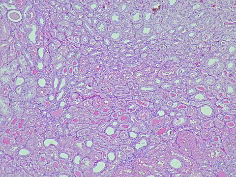 Photomicrograph of pyonephrosis + angiomyolipoma in a patient diagnosed with pyonephrosis sinistra in the anatomical pathology laboratory