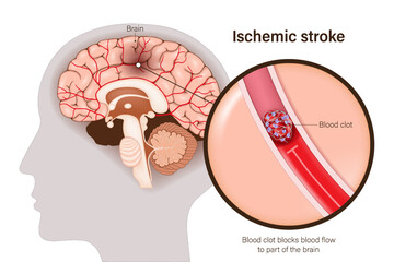 Ischemic stroke vector. Blood clot blocks blood flow
to part of the brain. Thrombosis. Brain tissue death.
