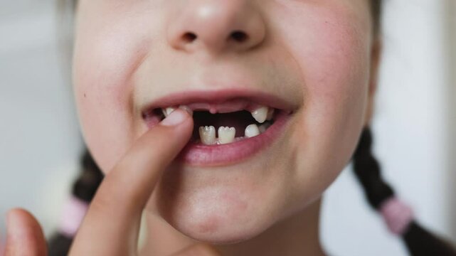 Close-up portrait of Caucasian girl with braided hair showing her missing baby teeth. Young child experiencing natural tooth loss in cozy home setting.