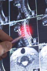 Vertical photo, Doctor examining MRI neck spine. X-ray scan. Spondylosis of the cervical spine....