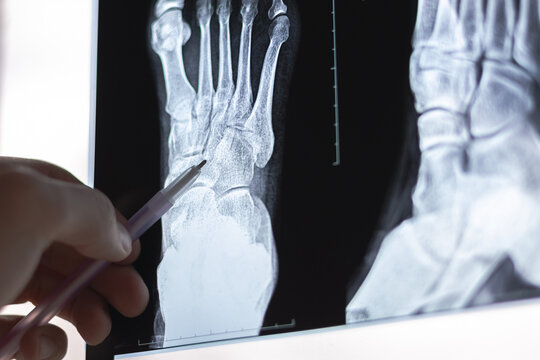 Doctor learning X-ray of foot fingers. Radiography foot bones. Metatarsal, Tarsals, Phalanges bone. Treatment of Sprains and dislocations of the muscles and bones of the foot.