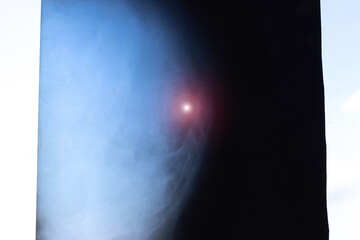 Human Skull X-ray radiography. Head injury. Disease of brain. Tumor in the head.