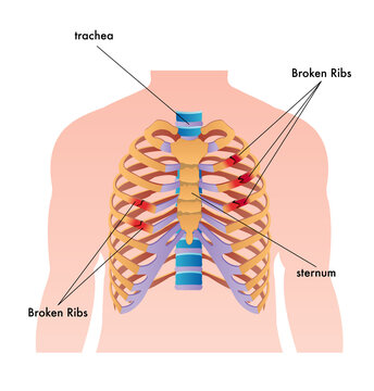 Medical illustration of broken ribs in the human body, with annotations