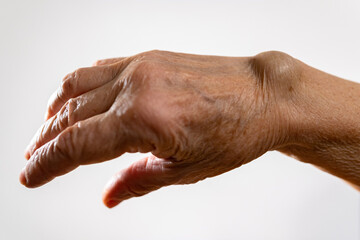 Fototapeta premium Ganglion cyst on the arm of an elderly woman on a white background