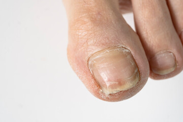 Broken nail on the big toe on a white background.