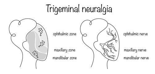 Trigeminal neuralgia
