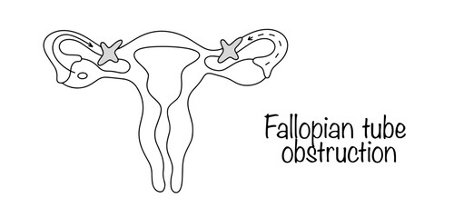 Fallopian tube obstruction