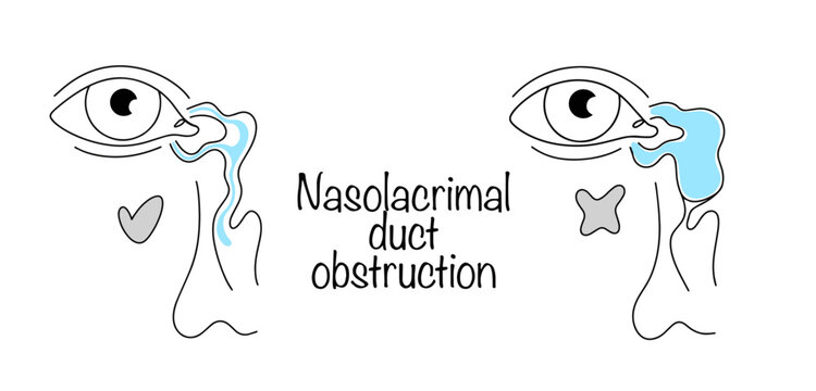 Nasolacrimal duct obstruction
