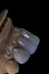Glass ceramic laminate veneers, known as dental laminates in dental aesthetic dentistry. Dental veneers. E-Max dental crowns. Smile makeover and smile design treatment.

