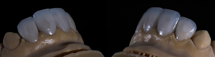 Glass ceramic laminate veneers, known as dental laminates in dental aesthetic dentistry. Dental veneers. E-Max dental crowns. Smile makeover and smile design treatment.  © UniqDream