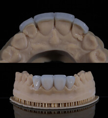 Glass ceramic laminate veneers, known as dental laminates in dental aesthetic dentistry. Dental veneers. E-Max dental crowns. Smile makeover and smile design treatment.  © UniqDream