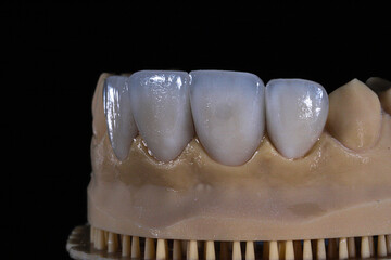 Dental porcelain crowns. Dental laminate veneers in smile design treatment in dentistry. Smile makeover.  © UniqDream