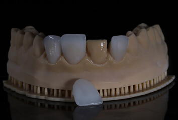 Computer-aided smile design treatment with porcelain crowns in digital dental dentistry. Digital jaw model with laminate veneers for dental smile design. Smile makeover. © UniqDream