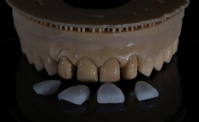 Computer-aided smile design treatment with porcelain crowns in digital dental dentistry. Digital jaw model with laminate veneers for dental smile design. Smile makeover. © UniqDream