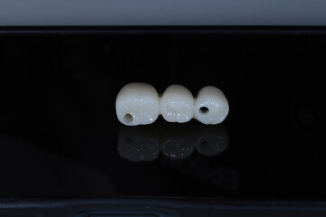 In dental and cosmetic dentistry, bone-anchored dental implant treatment with porcelain bridge prostheses and implant screws.  © UniqDream