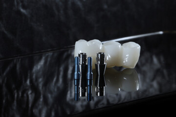 In dental and cosmetic dentistry, bone-anchored dental implant treatment with porcelain bridge prostheses and implant screws.  © UniqDream