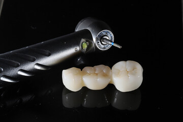 In dental and cosmetic dentistry, bone-anchored dental implant treatment with porcelain bridge prostheses and implant screws.  © UniqDream