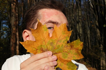 Young man face with autumn allergic skin rash and yellow maple leaf in hand. Photo 21 October 2024 year.