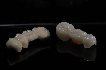E-max or zirconia glass ceramic porcelain bridge crown treatment and implant-supported crown treatment used in dental dentistry for cases of tooth loss. Smile design. © UniqDream