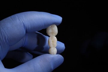 E-max or zirconia glass ceramic porcelain bridge crown treatment and implant-supported crown treatment used in dental dentistry for cases of tooth loss. Smile design.