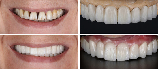 In dental aesthetic dentistry, smile design treatment with laminate veneers and zirconium crowns. Smile makeover dental before and after. © UniqDream