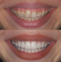 A beautiful woman with full lips undergoes a smile design treatment using E-max and zirconium porcelains to replace discolored and decayed teeth. The process includes dental before-and-after © UniqDream