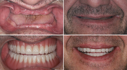 In dentistry, dental implant treatment involves placing a full arch dental prosthesis on 4 implants. The process includes dental before-and-after images and X-ray images. smile makeover. © UniqDream