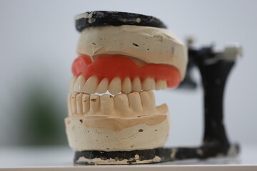 Full arch dental prosthesis treatment applied to edentulous jaws. The complete denture, known as a total prosthesis, is made from acrylic. The denture is displayed on a plaster model called an artic