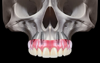 In dentistry, dental implant treatment involves placing a full arch dental prosthesis on 4 implants. The process includes dental before-and-after images and X-ray images. smile makeover. © UniqDream