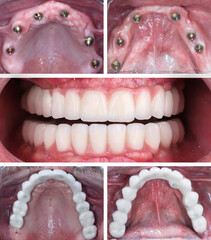 In dentistry, dental implant treatment involves placing a full arch dental prosthesis on 4...