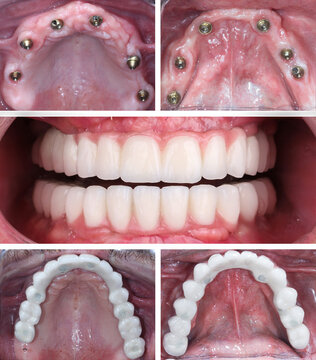 In dentistry, dental implant treatment involves placing a full arch dental prosthesis on 4 implants. The process includes dental before-and-after images and X-ray images. smile makeover.