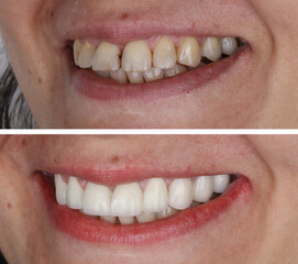 In dental aesthetic dentistry, smile design treatment with laminate veneers and zirconium crowns. Smile makeover dental before and after.