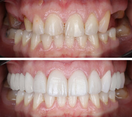 In dental aesthetic dentistry, smile design treatment with laminate veneers and zirconium crowns. Smile makeover dental before and after. © UniqDream