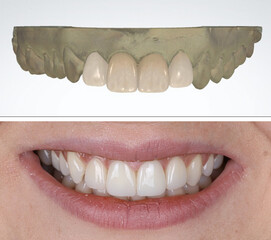 In dental aesthetic dentistry, smile design treatment with laminate veneers and zirconium crowns. Smile makeover dental before and after. © UniqDream