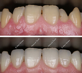 Aesthetic smile design treatment in dental dentistry. Dental treatment with laminate veneers, dental implants, and porcelain crowns. Smile makeover and dental before and after.   © UniqDream