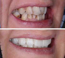 In dental aesthetic dentistry, smile design treatment with laminate veneers and zirconium crowns. Smile makeover dental before and after. © UniqDream