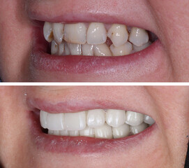 In dental aesthetic dentistry, smile design treatment with laminate veneers and zirconium crowns....