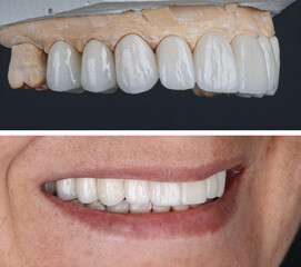 In dental aesthetic dentistry, smile design treatment with laminate veneers and zirconium crowns. Smile makeover dental before and after. © UniqDream