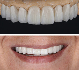 In dental aesthetic dentistry, smile design treatment with laminate veneers and zirconium crowns. Smile makeover dental before and after. © UniqDream