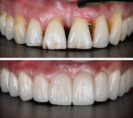 In dental aesthetic dentistry, smile design treatment with laminate veneers and zirconium crowns. Smile makeover dental before and after. © UniqDream