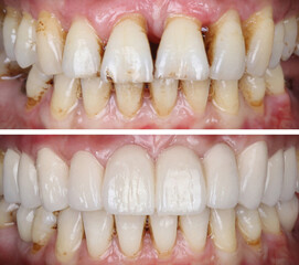 In dental aesthetic dentistry, smile design treatment with laminate veneers and zirconium crowns. Smile makeover dental before and after. © UniqDream