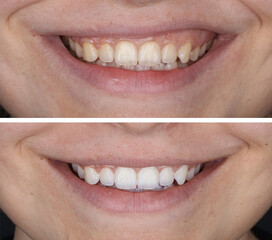 Aesthetic smile design treatment in dental dentistry. Dental treatment with laminate veneers, dental implants, and porcelain crowns. Smile makeover and dental before and after.   © UniqDream